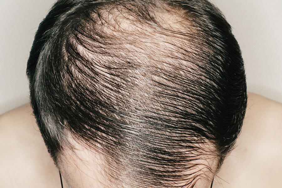 Man with hair combed over bald patch, overhead view