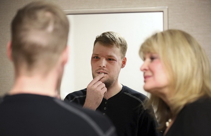 In this Jan. 24, 2017, photo, face transplant recipient Andy Sandness looks in a mirror during an appointment with physical therapist Helga Smars, right, at Mayo Clinic in Rochester, Minn. He wasn't allowed to see himself immediately after the surgery. His room mirror and cell phone were removed. When he finally did see his face after three weeks, he was overwhelmed. "Once you lose something that you've had forever, you know what it's like not to have it. ... And once you get a second chance to have it back, you never forget it." Just having a nose and mouth are blessings, Sandness says. "The looks are a bonus." (AP Photo/Charlie Neibergall)